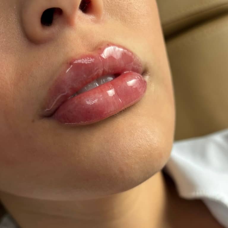 sa-lip-filler-1