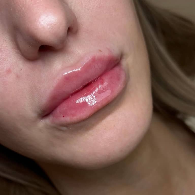 Natural Looking Lip Fillers In Scottsdale Sloan Aesthetics 